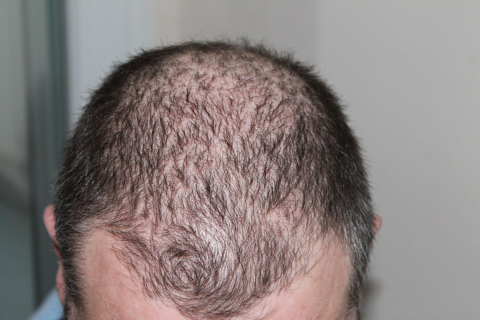 Hair Loss » Newcastle Health - Private GP Clinic